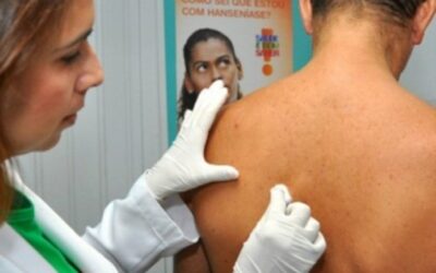 Janeiro Roxo: casos de Hanseníase diminuem em Campo Grande