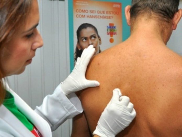 Janeiro Roxo: casos de Hanseníase diminuem em Campo Grande