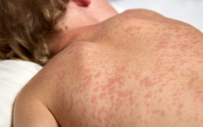 Busca ativa por casos de sarampo é intensificada em MS com apoio do Ministério da Saúde