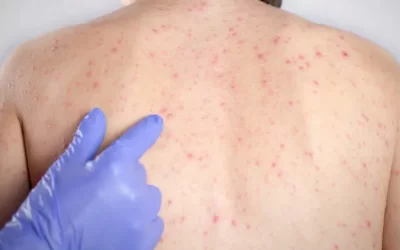 Casos no exterior acendem alerta para reintrodução do sarampo em MS