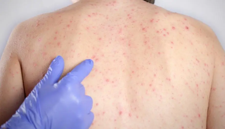 Casos no exterior acendem alerta para reintrodução do sarampo em MS