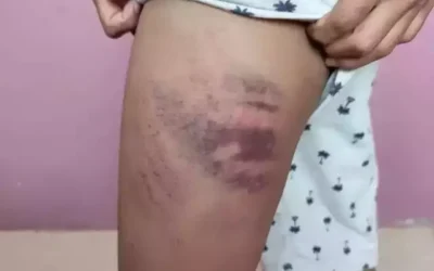 Investigação conclui que mãe agrediu filho autista e culpou colega de escola