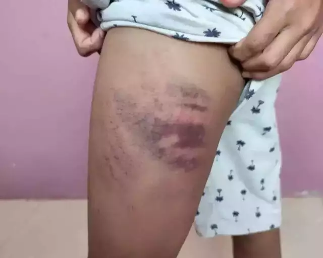 Investigação conclui que mãe agrediu filho autista e culpou colega de escola