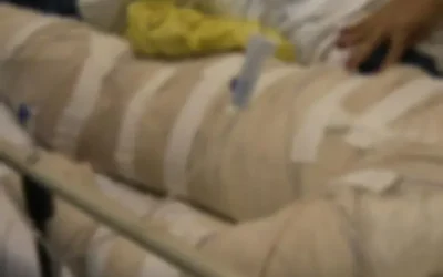 Adolescente que colocou fogo em menino com álcool é apreendido em Campo Grande